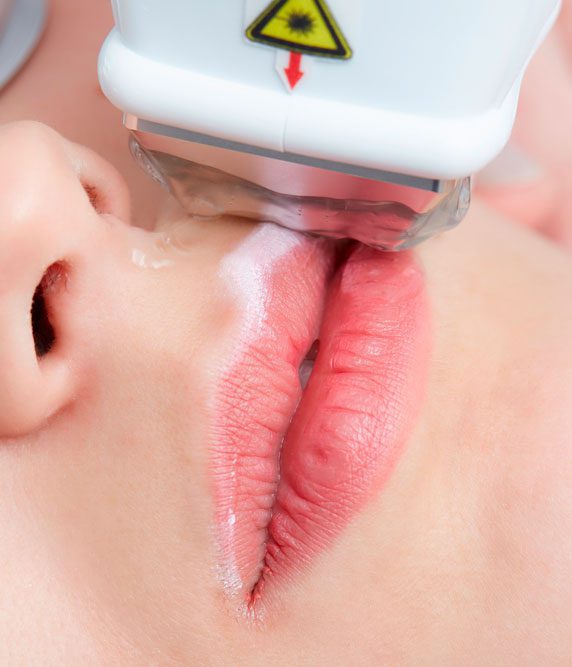 Laser hair removal
